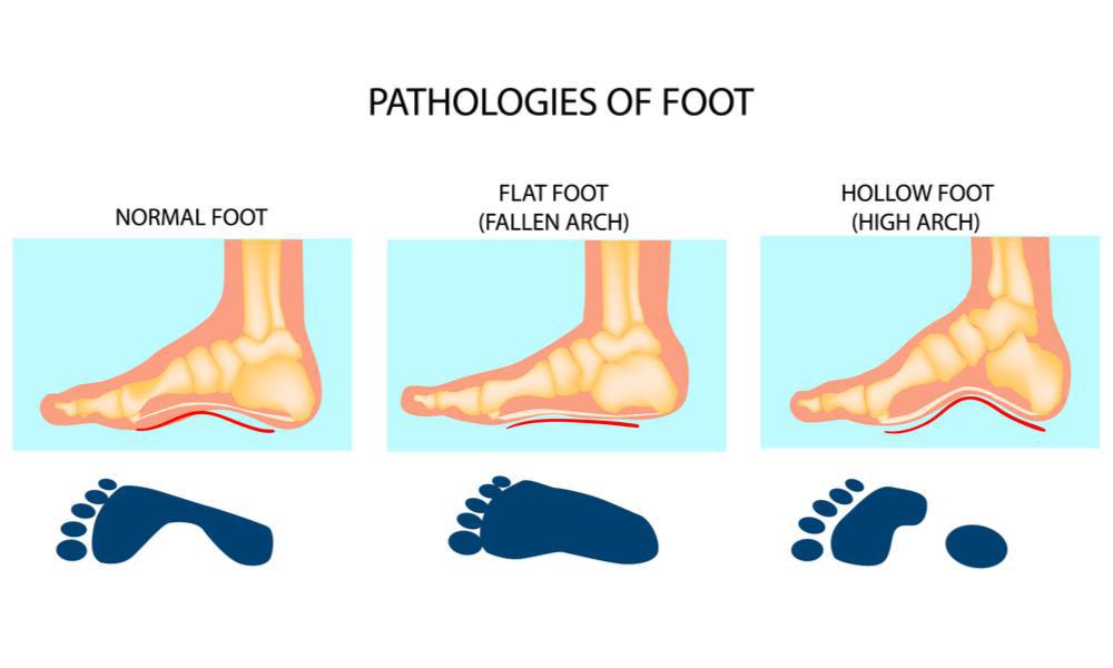 How-Should-Sandals-Fit-2